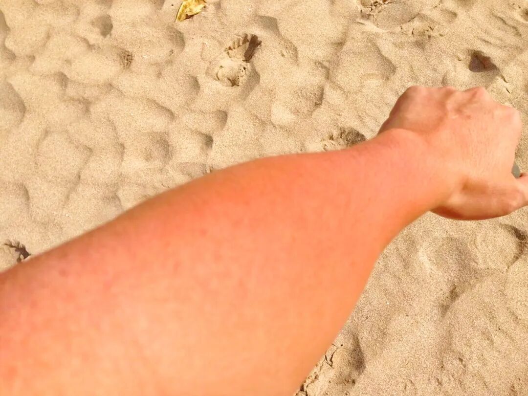 A person's arm showing severe sunburn and peeling skin after sun exposure in Kenting